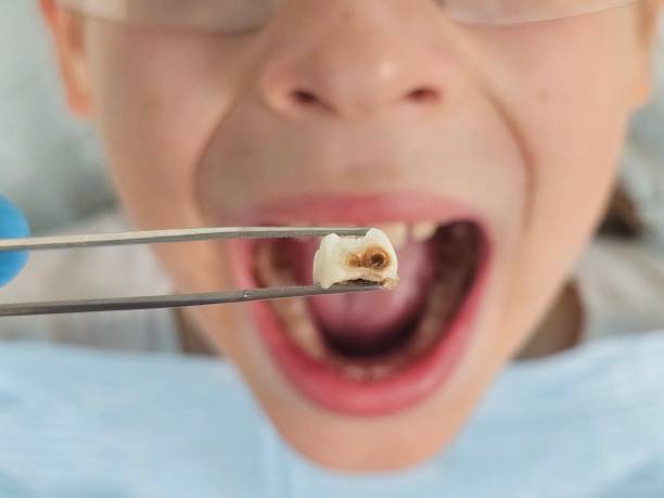 Best Emergency Care for Gum Disease in New Brighton, MN